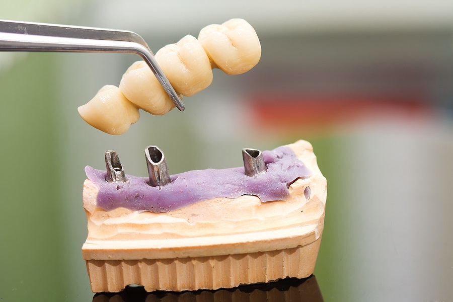 Your New Bridge as Part of your Oral Hygiene Routine