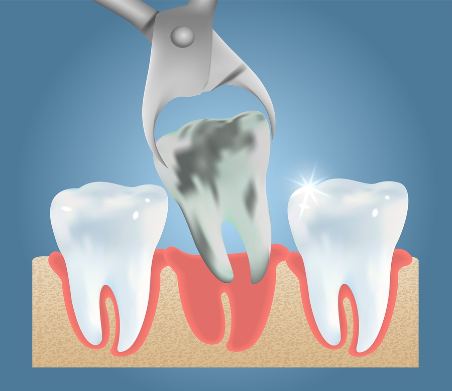 How to Prepare Yourself for an Extraction