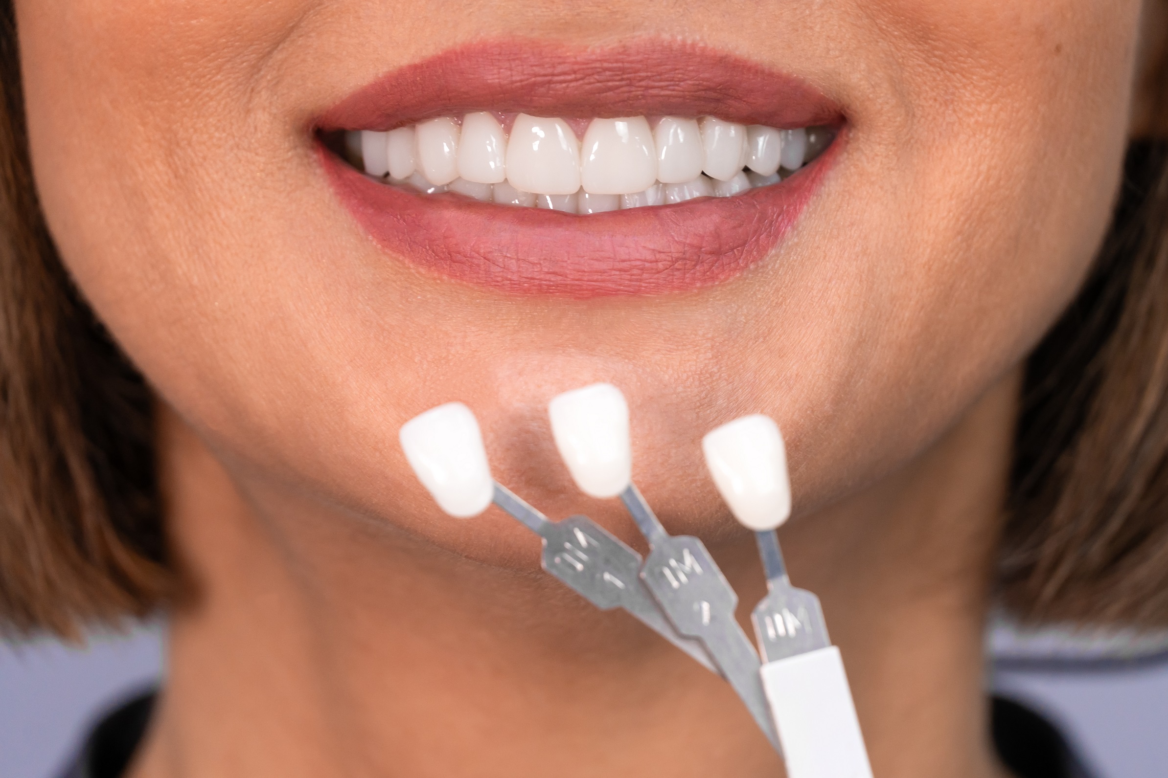 Do Veneers Need to Be Replaced?